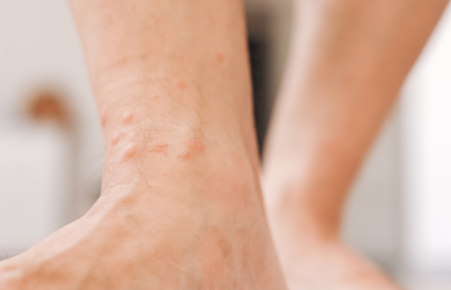 ¿Alergia al sol?
