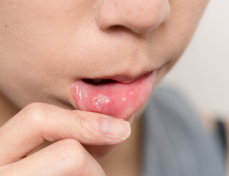 ¿Qué debo saber sobre el liquen plano?